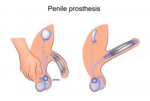 Inflatable penile implant
